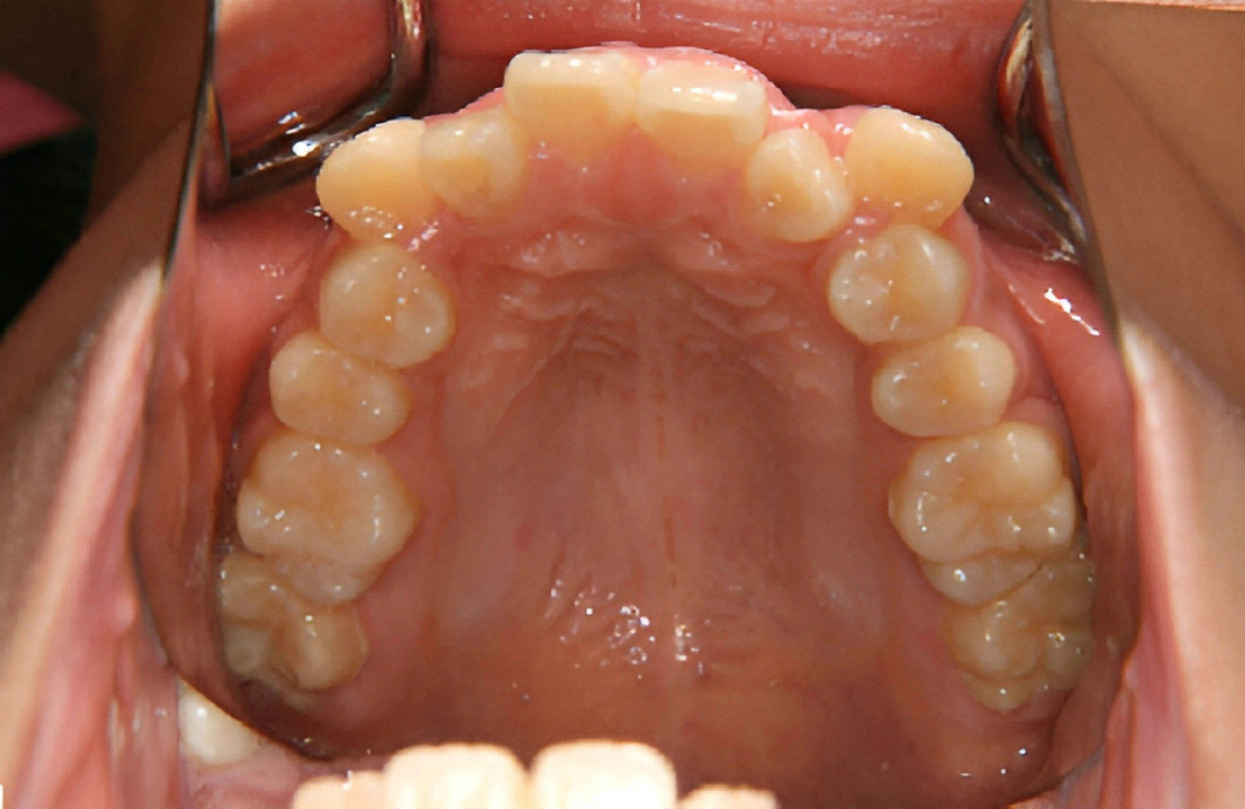 症例1　治療前　上顎