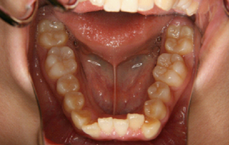 症例1　治療前　下顎