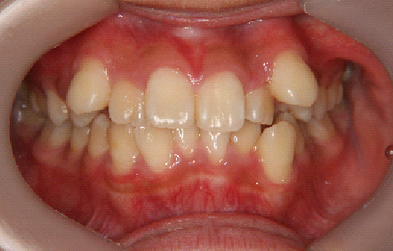 症例1　治療前　正面