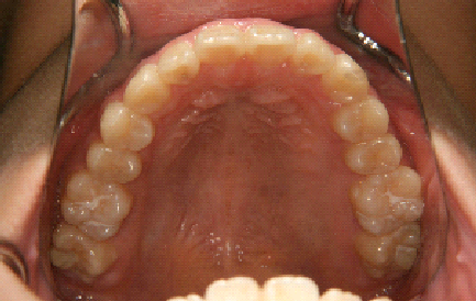 症例1　治療後　上顎