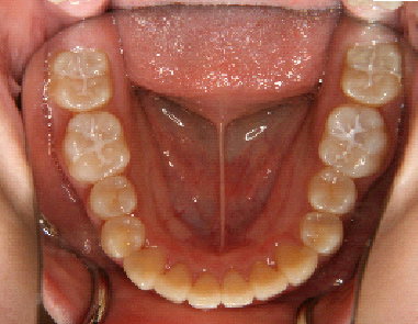 症例1　治療後　下顎