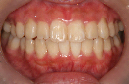 症例1　治療後　正面
