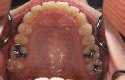 症例2　治療後　上顎