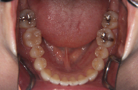 症例2　治療後　下顎