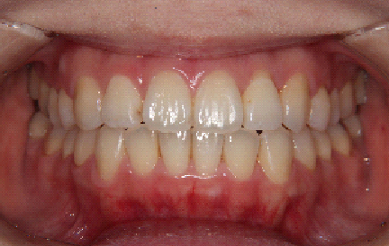 症例2　治療後　正面