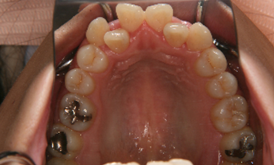 症例3　治療前　上顎