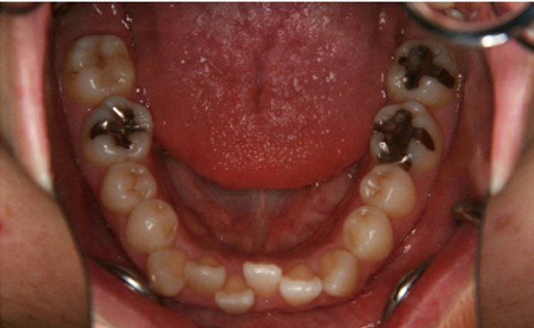 症例3　治療前　下顎