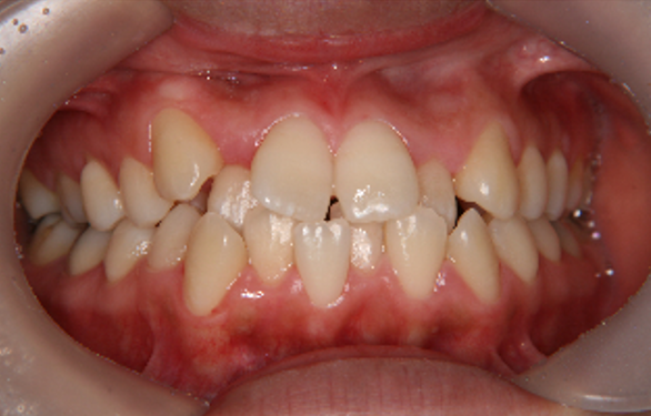 症例3　治療前　正面