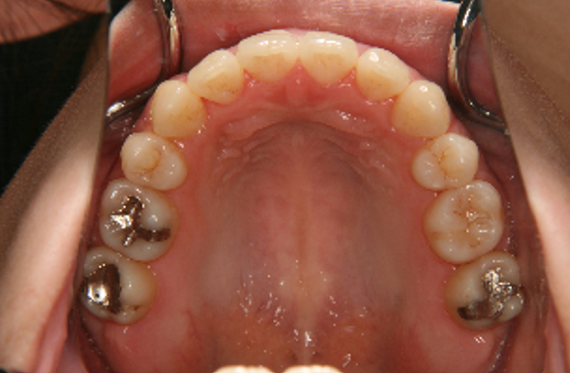 症例3　治療後　上顎