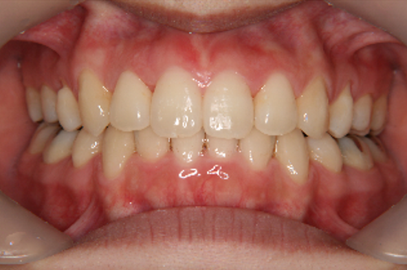 症例3　治療後　正面