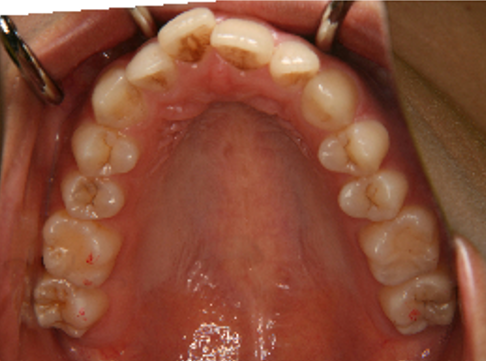 症例4　治療前　上顎