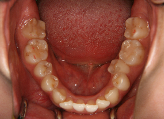 症例4　治療前　下顎
