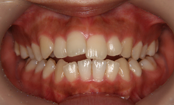 症例4　治療前　正面