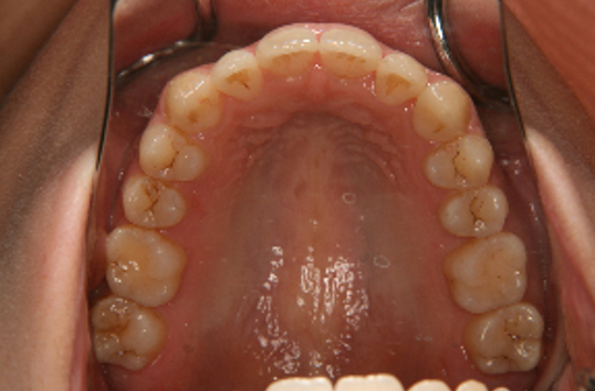 症例4　治療後　上顎