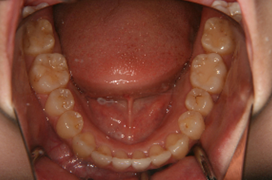 症例4　治療後　下顎