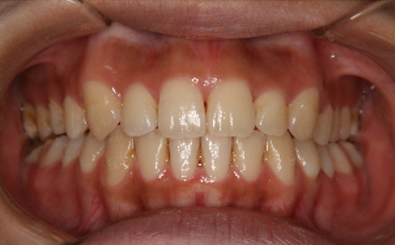 症例4　治療後　正面