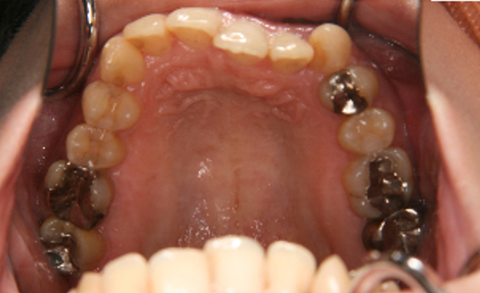 症例5　治療前　上顎