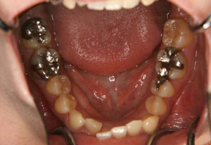 症例5　治療前　下顎