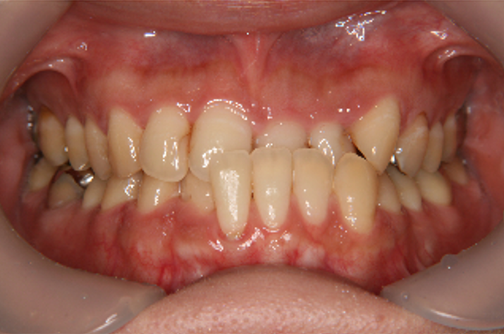 症例5　治療前　正面