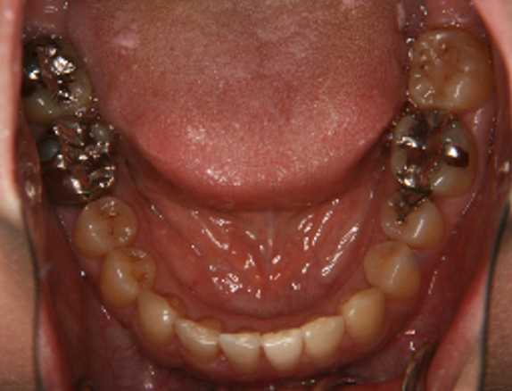 症例5　治療後　下顎