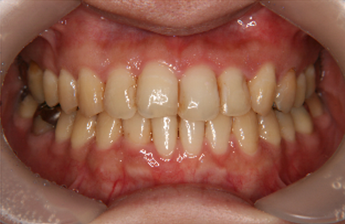 症例5　治療後　正面