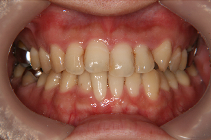 症例5　治療途中　正面