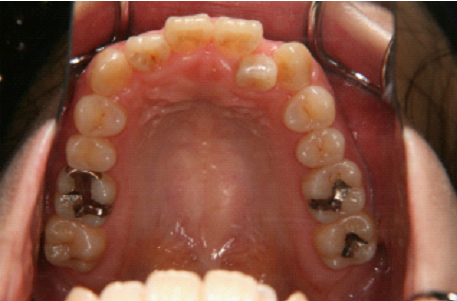 症例２　治療前　上顎