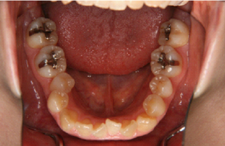 症例２　治療前　下顎
