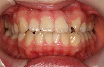 症例２　治療前　正面