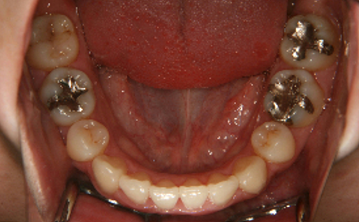症例３　治療後　下顎