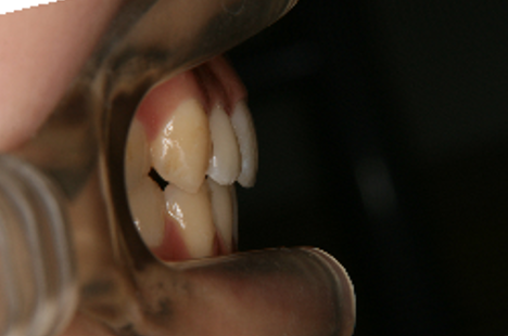 症例４　治療後　側方