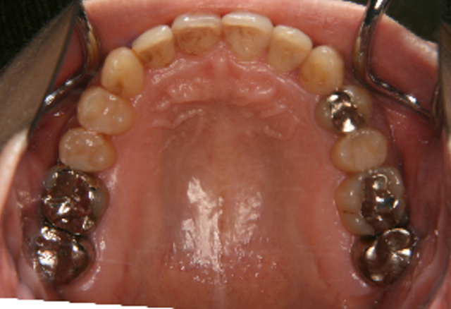 症例５　治療後　上顎